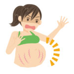 【体験談】妊娠線のメカニズムと妊娠線の予防方法、オススメのグッズ
